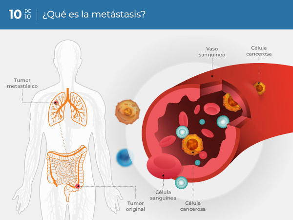 10-ES_what-is-metastasis